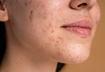 Tips Merawat Kulit yang Berjerawat