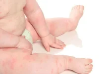 Tips Mengobati Biduran pada Anak