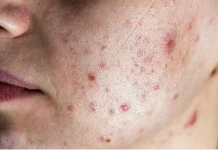 Tips Ampuh Menghilangkan Jerawat Batu di Pipi Secara Alami!