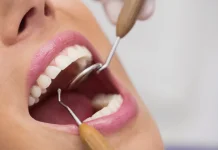 Tips Menghilangkan Karang Gigi dengan Aman