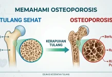 Mengenal Osteoporosis dan Cara Mencegahnya sejak Dini