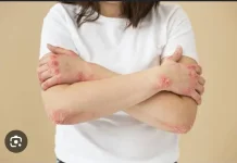 10 Faktor Resiko dan Pemicu Autoimun pada Wanita