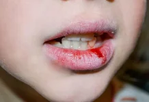 Tips Menjaga Bibir Tetap Sehat dan Tidak Pecah-Pecah