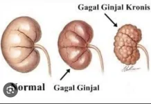 Penyebab Ginjal Orang Indonesia Cepat Rusak