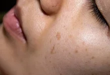 Penyebab Flek Hitam di Wajah yang Jarang diketahuai