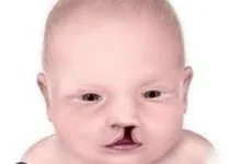 Risiko Operasi Bibir Sumbing pada Bayi Usia 3 Bulan