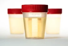Warna Urine Bisa Jadi Petunjuk Kondisi Kesehatan Ginjal Anda