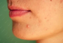 Cara Mengatasi Jerawat yang Gatal