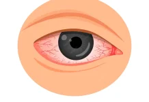 Kemenkes RI Ingatkan, Cegah Computer Vision Syndrome
