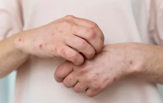 Cara Mengatasi Kutu Air di Jari Tangan