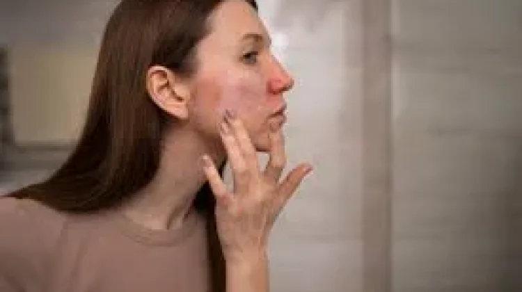 Lupus Terkontrol, Hidup Tetap Optimal