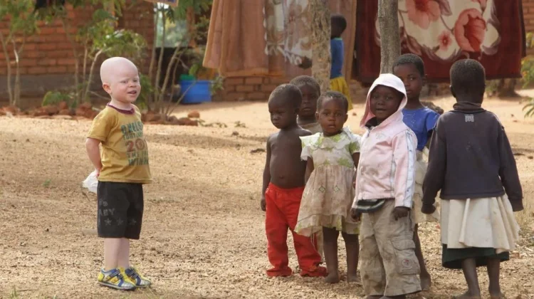 Penyandang Albino Rentan Gangguan Penglihatan dan Stigma Sosial