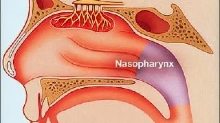 Waspadai Gejala Kanker Nasofaring, Deteksi Dini Jadi Kunci Pengobatan