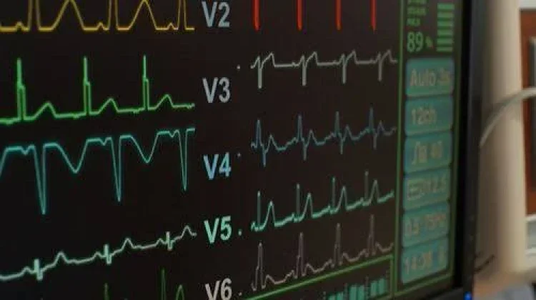 Fibrilasi Atrium Tingkatkan Risiko Stroke