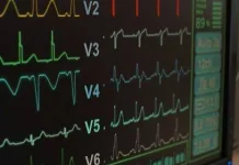 Fibrilasi Atrium Tingkatkan Risiko Stroke