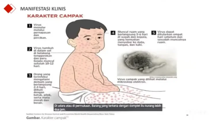 Dokter Samarinda Ungkap Perbandingan Fatalitas jika Tolak Vaksin Campak