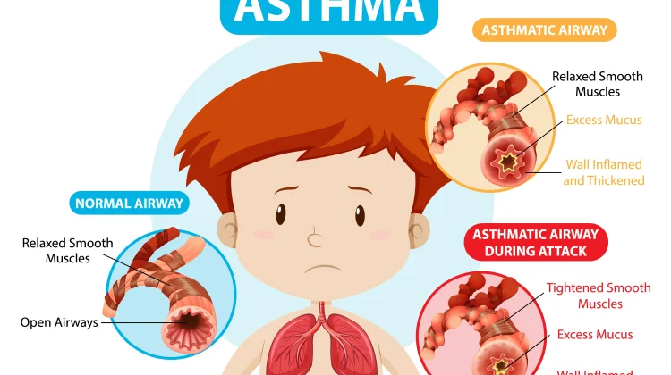 Global Initiative for Asthma Dorong Edukasi Asma Tingkatkan Kualitas Hidup