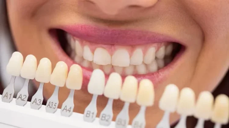 Bleaching dan Vinir Gigi Tidak Bisa Sembarangan