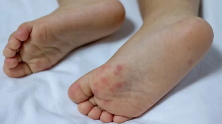 Anak Bisa Terkena Flu Singapura Lebih dari Sekali