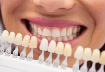 Bleaching dan Vinir Gigi Tidak Bisa Sembarangan