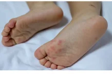 Anak Bisa Terkena Flu Singapura Lebih dari Sekali