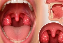 Anak Sering Amandel, Gangguan Tidur Bisa Jadi Penyebabnya