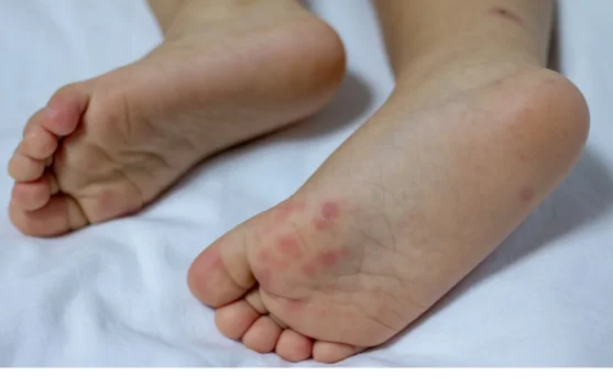 Anak Bisa Terkena Flu Singapura Lebih dari Sekali