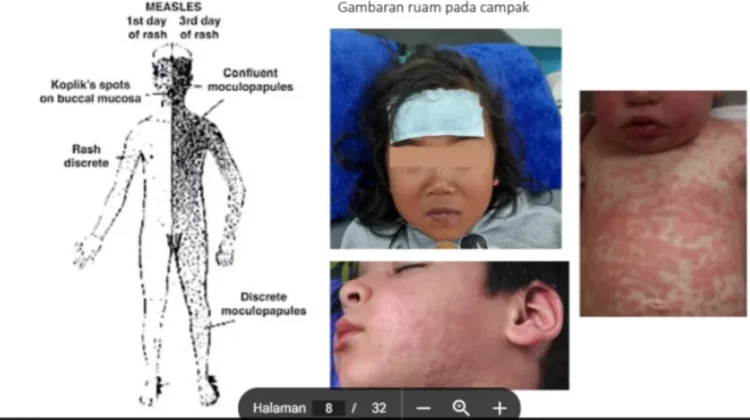 Waspada Campak saat Mudik, IDAI Imbau Orang Tua Lengkapi Imunisasi Anak