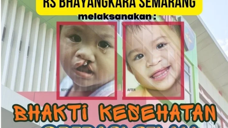 Polda Jateng Gelar Operasi Gratis Celah Bibir dan Lelangit di Semarang