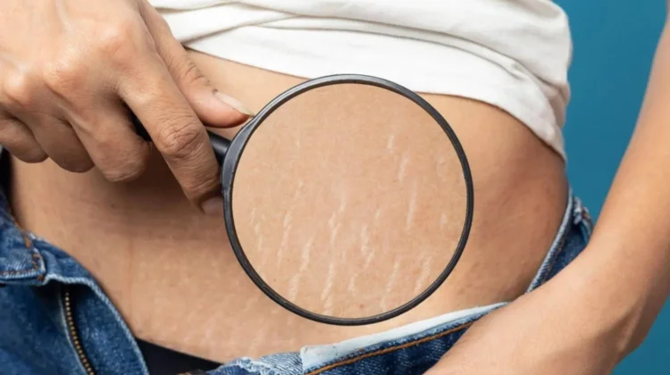 Bukan Hanya Ibu Hamil, Remaja juga Bisa Stretch Mark