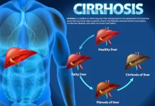 Formula Tri-Sinergi Sel Autologus, Menaklukkan Sirosis Tanpa Transplantasi