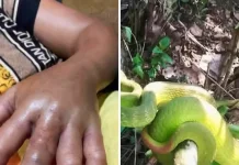 Pertolongan Pertama Gigitan Ular yang Wajib Diketahui