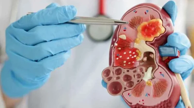 Jangan Abai, Kenali Gejala Awal Penyakit Ginjal