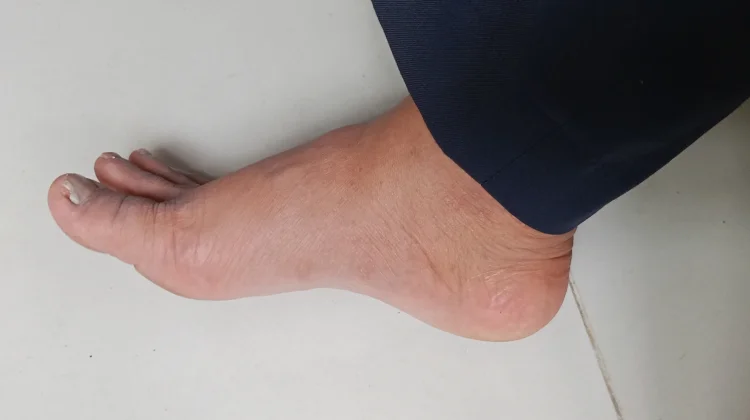 Jangan Abaikan, Tanda Kolesterol Bisa Terlihat di Kaki
