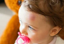 Langkah Tepat Tangani Memar pada Anak