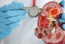 Jangan Abai, Kenali Gejala Awal Penyakit Ginjal