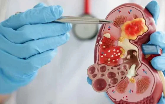 Jangan Abai, Kenali Gejala Awal Penyakit Ginjal