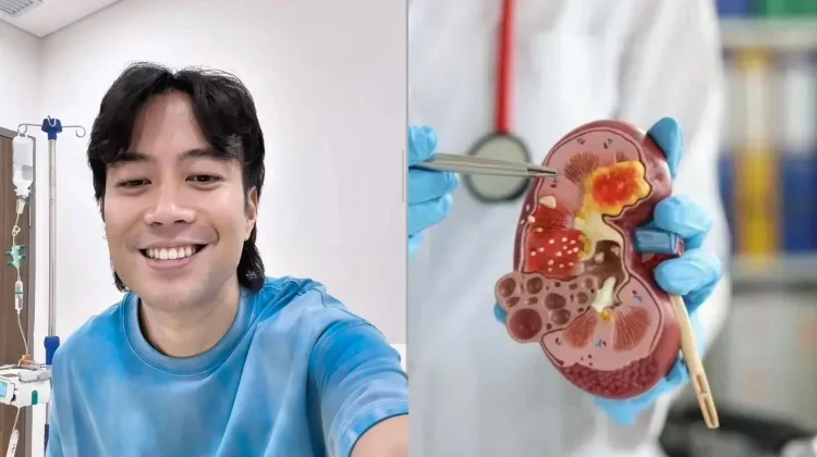 Mengenal Kanker Ginjal yang Diderita Almarhum Vidi Aldiano sejak 2019