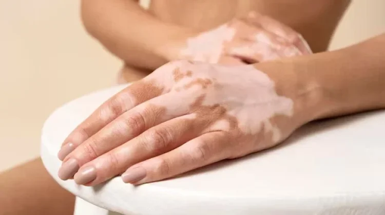 Hari Vitiligo Sedunia: Peringatan 25 Juni