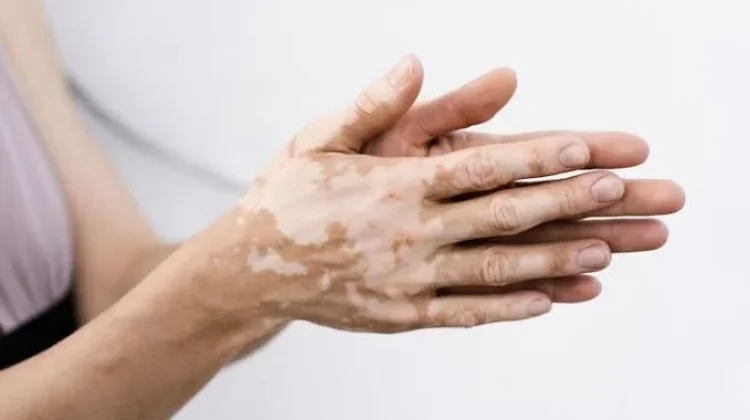 Hari Vitiligo Sedunia, Intip Sejarahnya