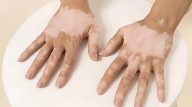 Ketahui Latar Belakang Peringatan Hari Vitiligo Sedunia