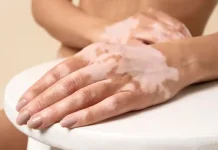 Hari Vitiligo Sedunia: Peringatan 25 Juni