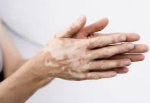 Hari Vitiligo Sedunia, Intip Sejarahnya