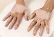 Ketahui Latar Belakang Peringatan Hari Vitiligo Sedunia