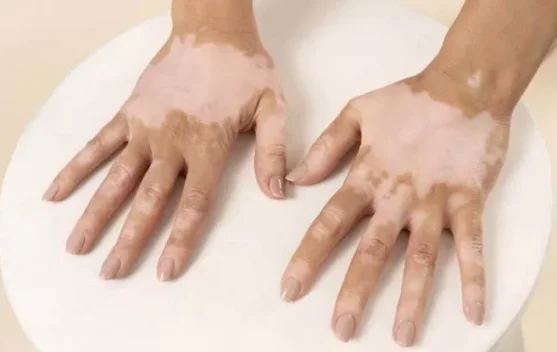 Ketahui Latar Belakang Peringatan Hari Vitiligo Sedunia