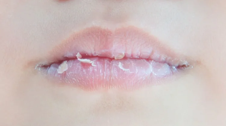 Tips Mengatasi Bibir Kering saat Puasa