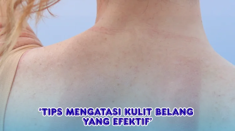 Tips Mengatasi Kulit Belang yang Efektif