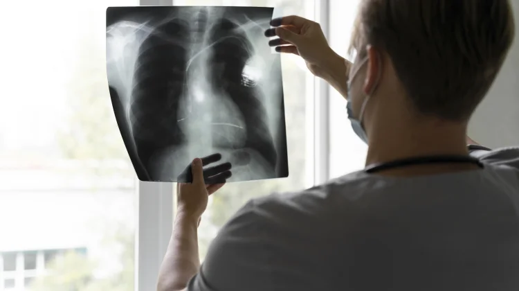 Kanker Paru Silent Killer, Deteksi Dini Tingkatkan Peluang Kesembuhan