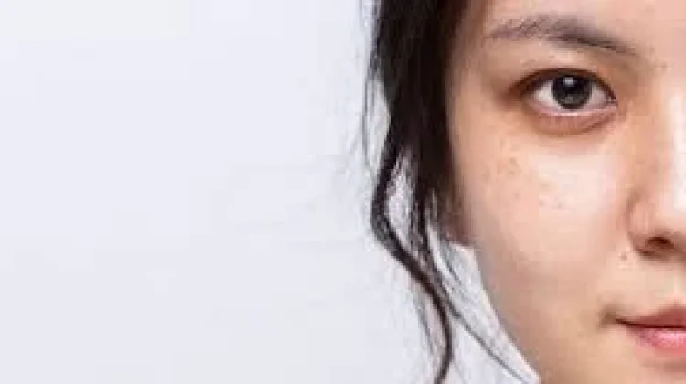 Cara Menghilangkan Flek Hitam di Wajah Secara Alami