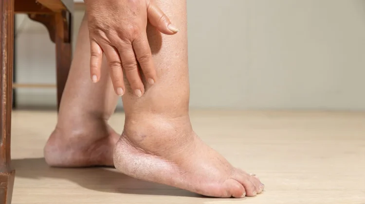 Jangan Abaikan Kaki Bengkak, Bisa Jadi Sinyal Ginjal
